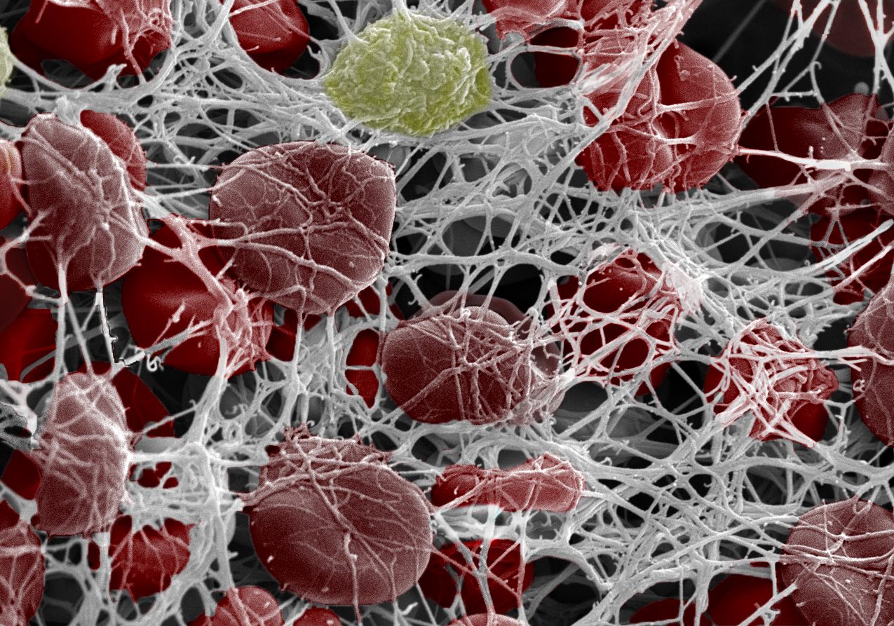 Innovative Treatment Targets Blood Clots Without Increased Bleeding Risk